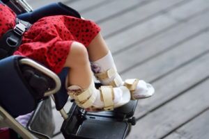 A child with erbs palsy in a wheelchair with braces on both legs