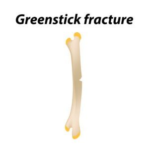 Greenstick fractures are often only seen in infants. If you suspect a broken bone in your infant, contact a birth injury attorney in Gilbert, AZ, by calling us.